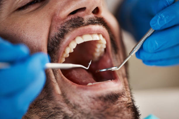 Best Knocked-Out Tooth (Avulsed Tooth) Treatment in Cheney, WA